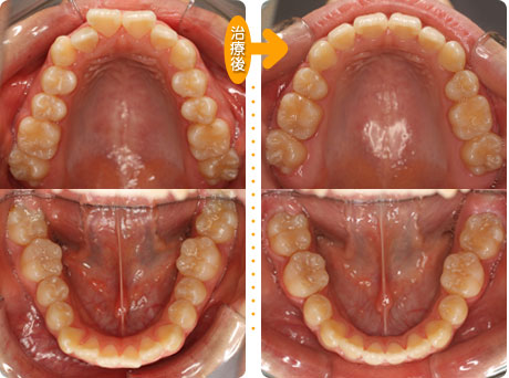 上顎前突(いわゆる出っ歯)上下の歯を４本抜いたケース