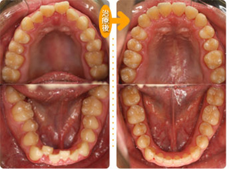 下顎前突(骨格性)顎変形症の一例～外科手術を併用して治したケース